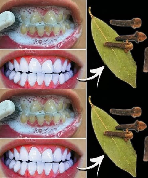 Remova o tártaro e clareie os dentes em poucos minutos